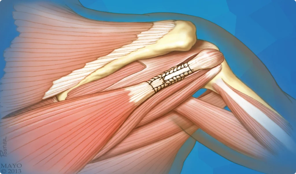 transfert tendineux 