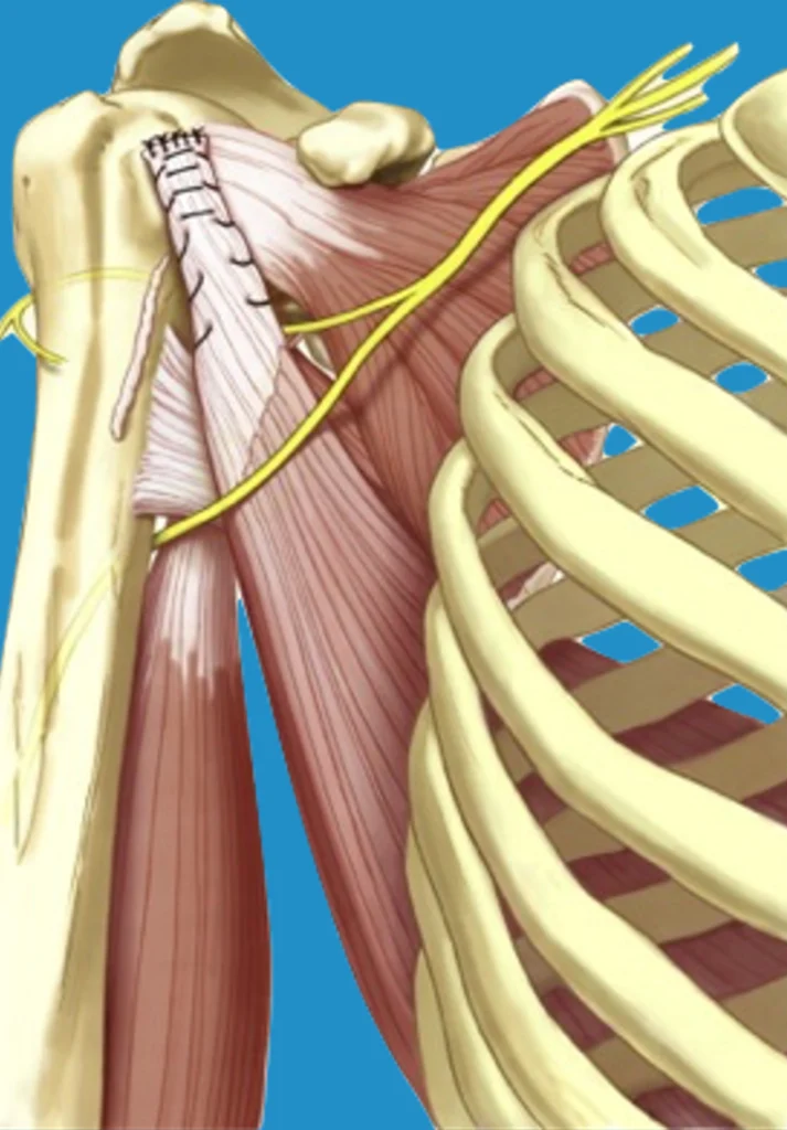 transfert tendineux 