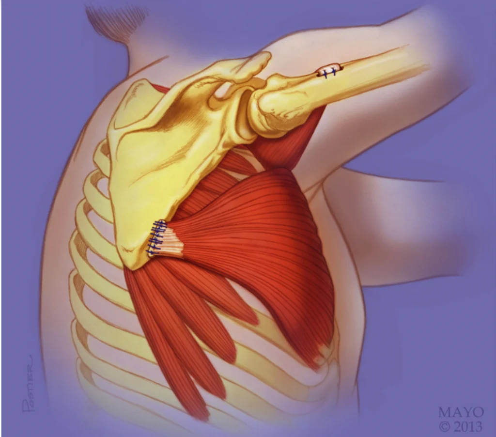 transfert tendineux 