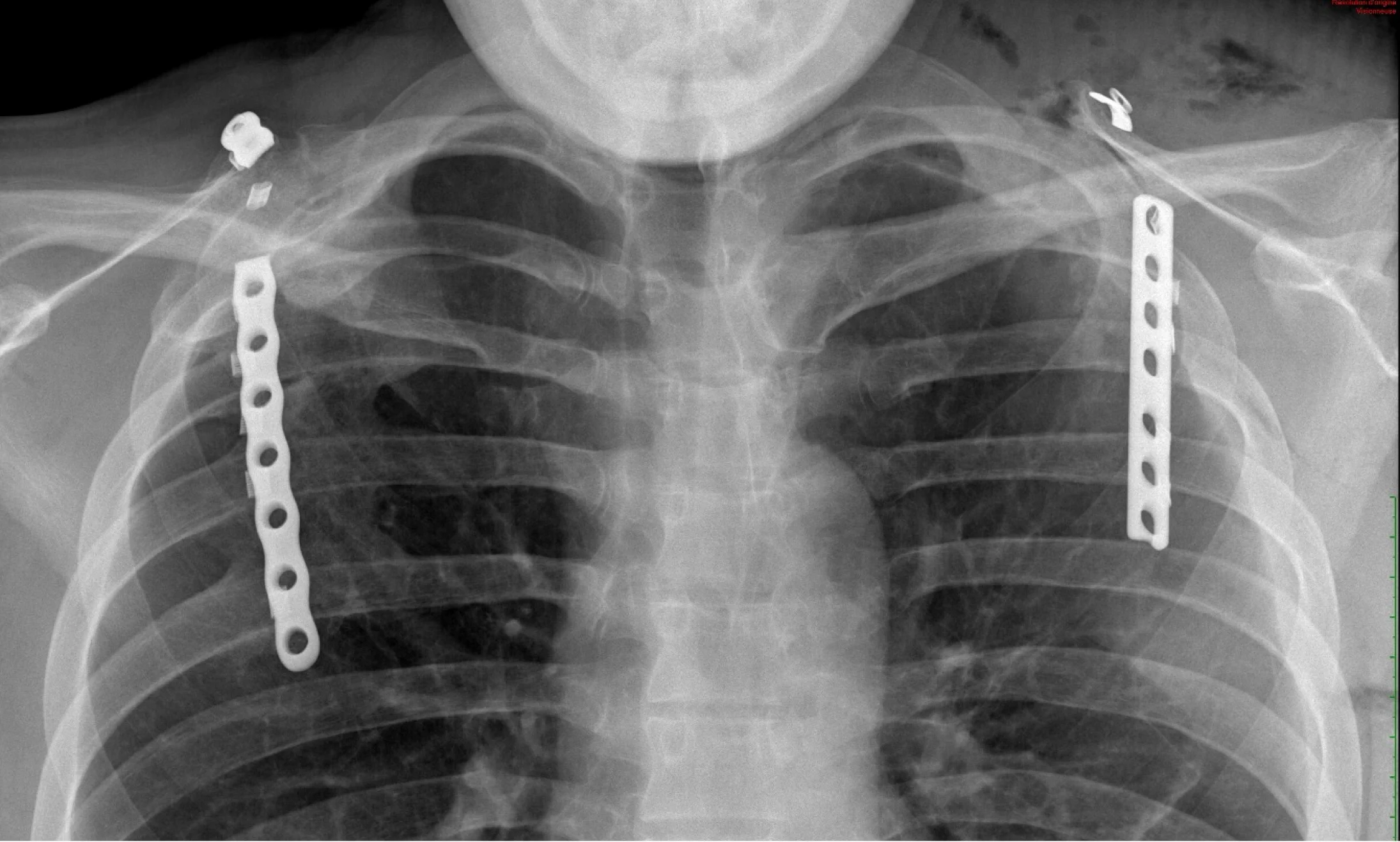 chirurgie-coiffe-rotateurs-rueil-malmaison