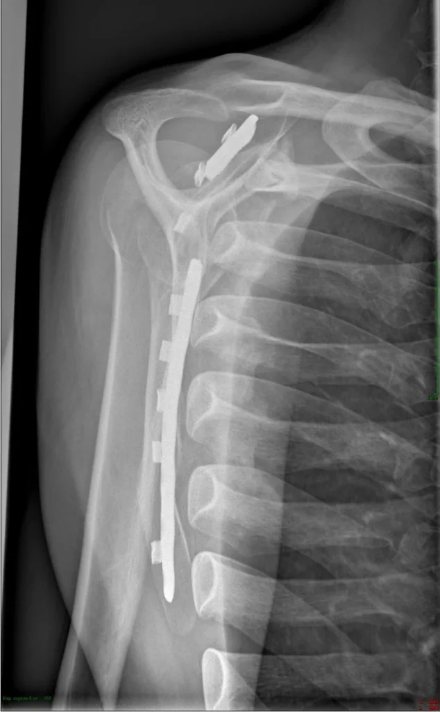 Arthrodèse scapulo-thoracique