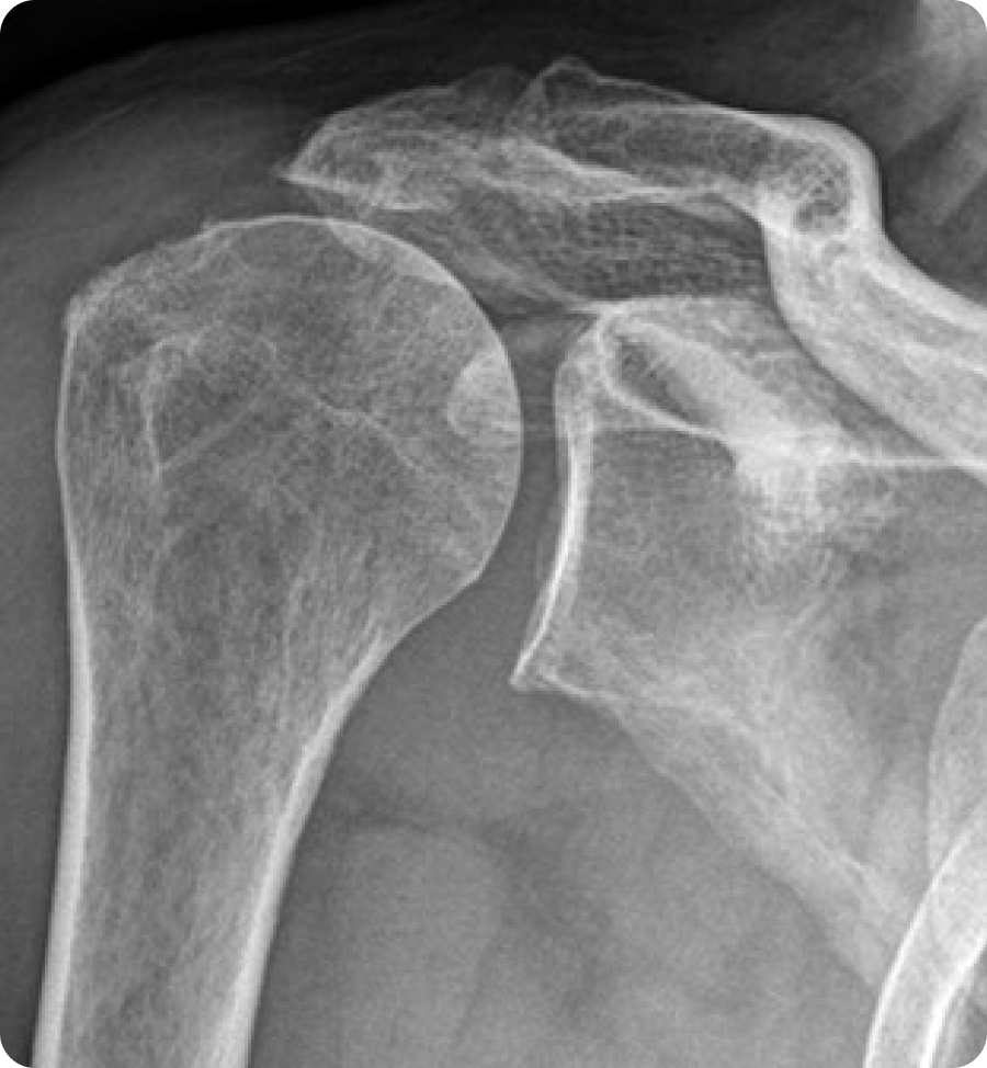 Rupture de la coiffe des rotateurs