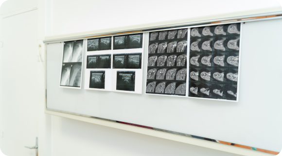 chirurgie-epaule-boulogne-billancourt