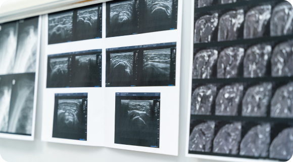 chirurgie-epaule-paris-ouest-15