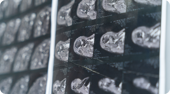 chirurgie-epaule-rueil-malmaison