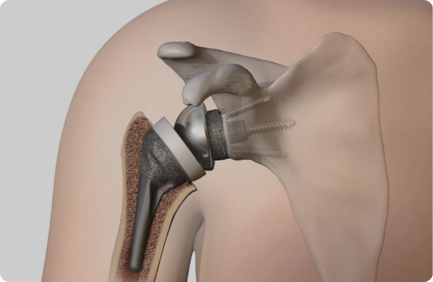 chirurgien-epaule-france