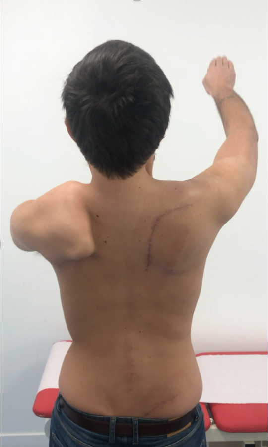 Arthrodèse scapulo-thoracique