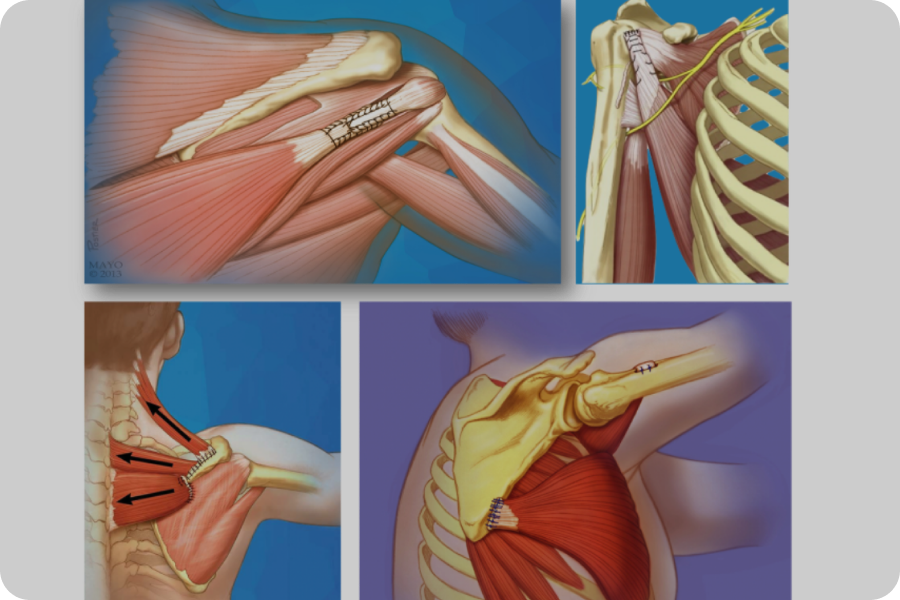 chirurgien-epaule-meudon