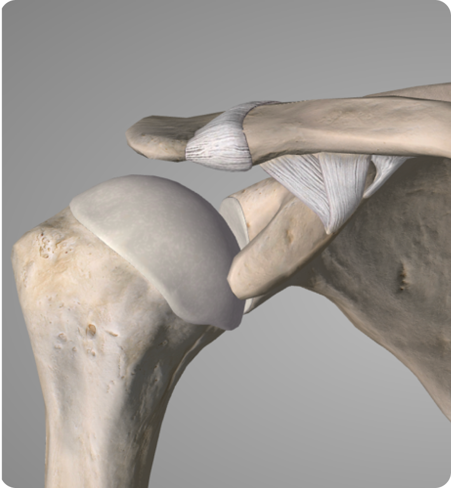 Disjonction acromio-claviculaire