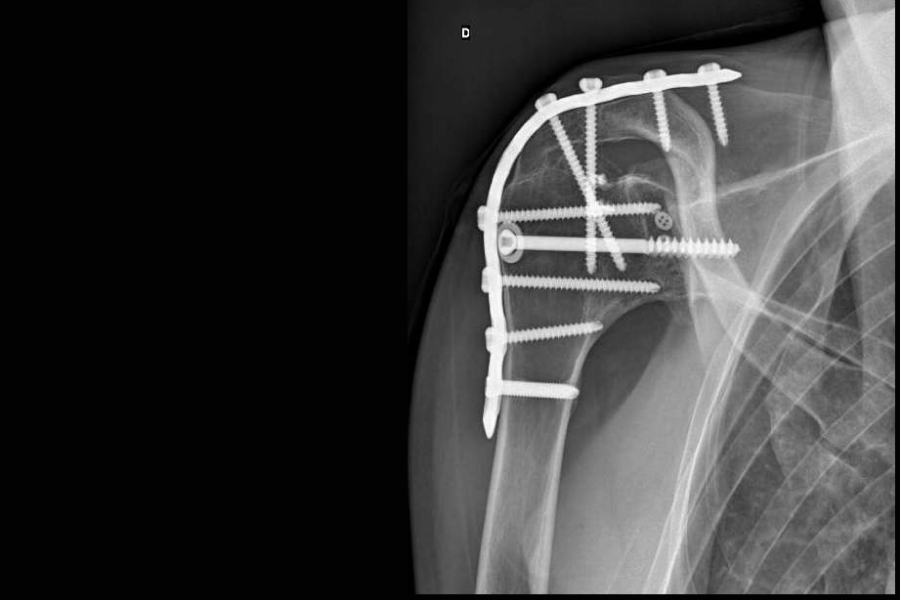 chirurgien-epaule-saint-germain-en-laye