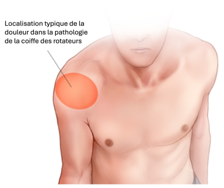Rupture de la coiffe des rotateurs