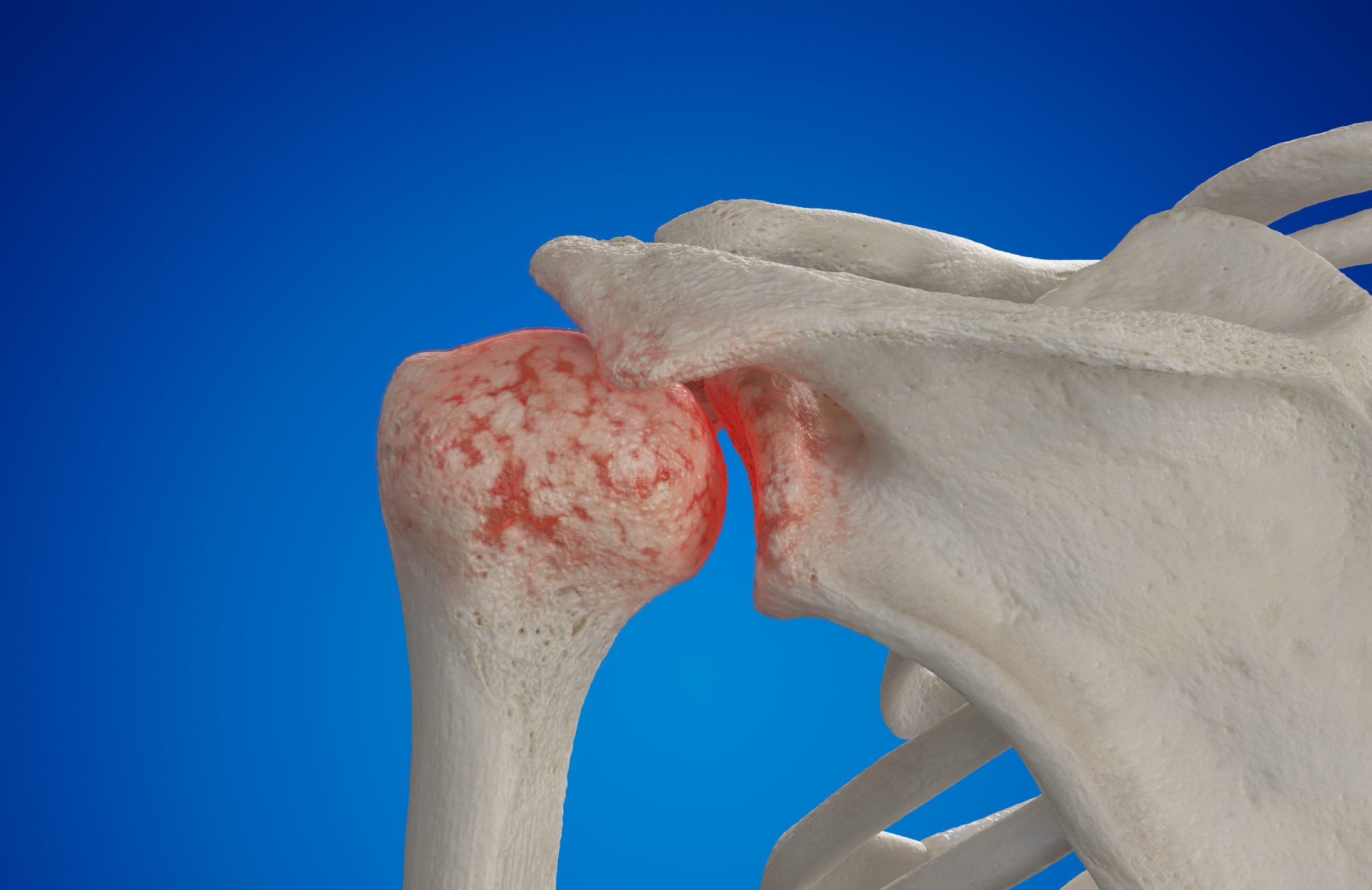 prothese-epaule-paris-ouest-8