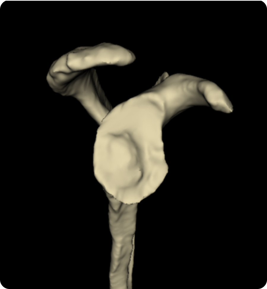 Arthrose de l’épaule