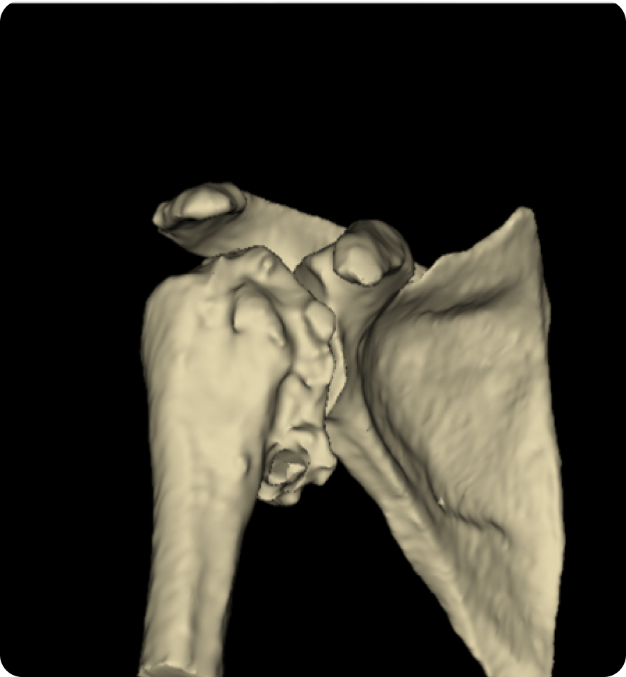 Arthrose de l’épaule