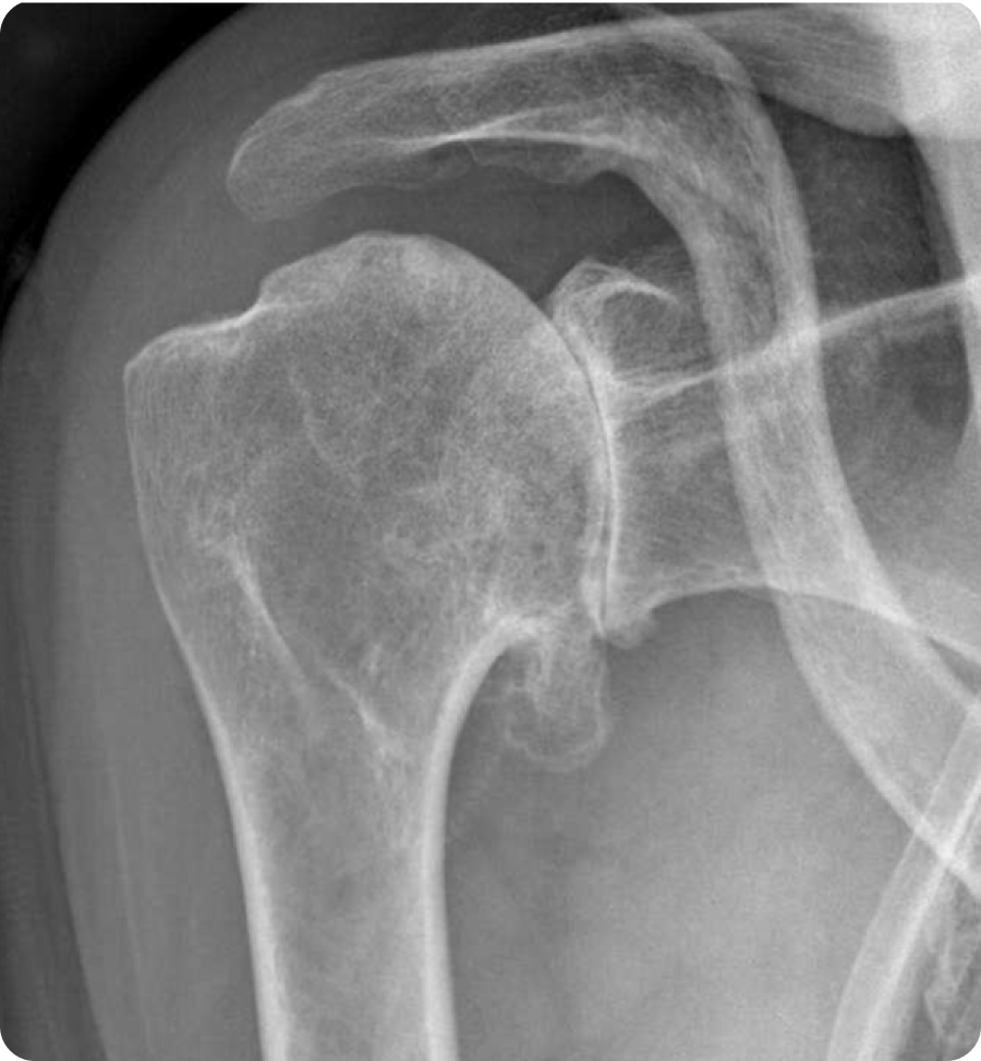 Arthrose de l’épaule