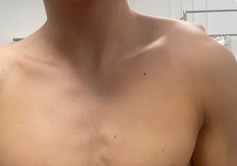 Disjonction acromio-claviculaire
