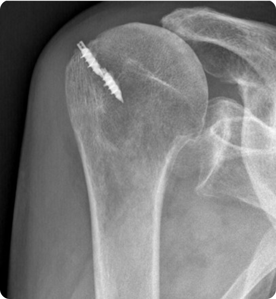 Arthrose de l’épaule