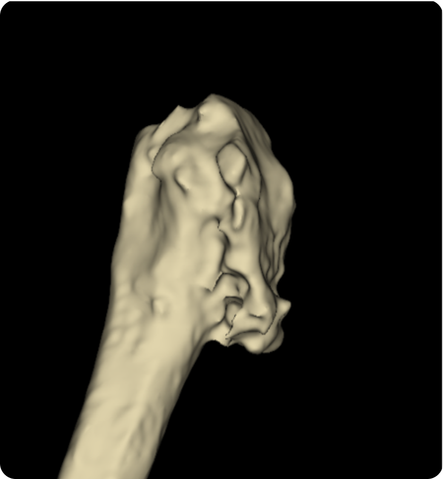 Arthrose de l’épaule