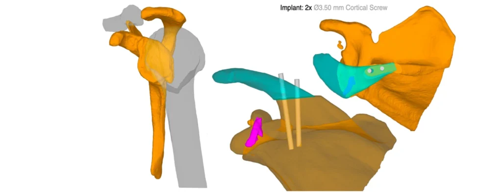 Traitement chirurgical non prothétique