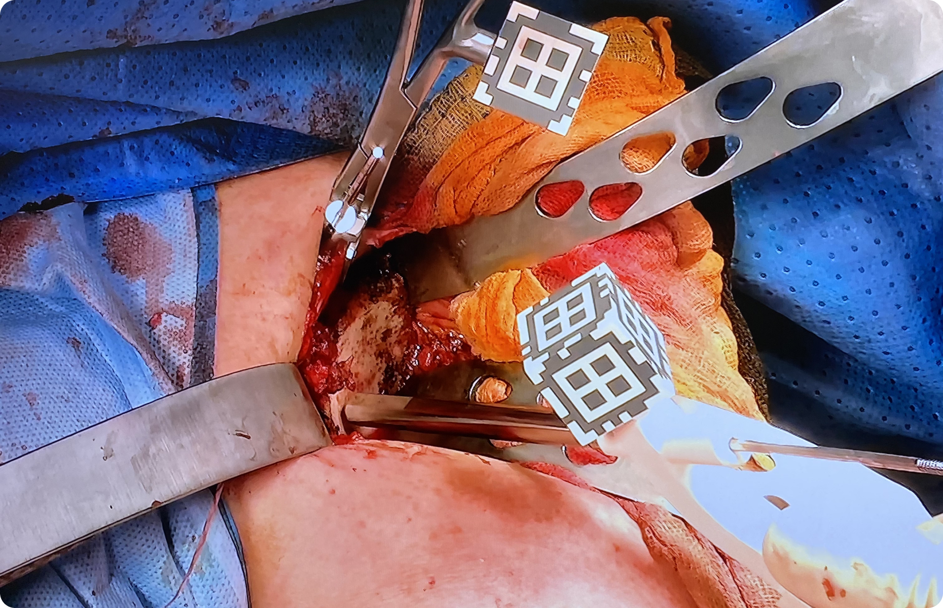 prothese-inverse-epaule-paris